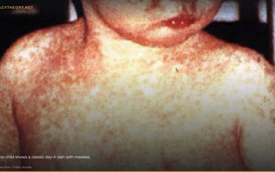 Vaccine–Autism Link